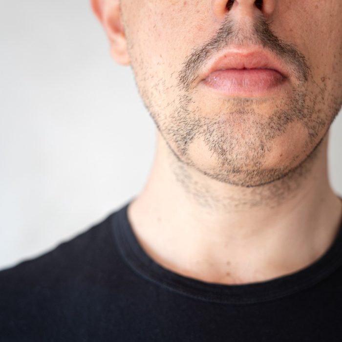 Alopecia Areata – SFD Alopecia Areata - SFD