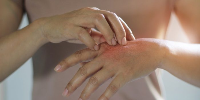 Healthcare and medical concept. Female scratching the itch on her hand, cause of itching from skin diseases, dry skin, allergy, chemical, allergic to detergent or dishwashing liquid and dermatitis, insect bites, burned, drug. Health problem.