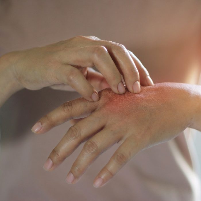 Healthcare and medical concept. Female scratching the itch on her hand, cause of itching from skin diseases, dry skin, allergy, chemical, allergic to detergent or dishwashing liquid and dermatitis, insect bites, burned, drug. Health problem.