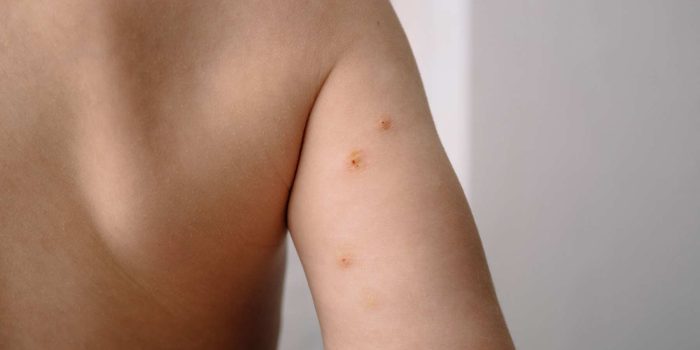 Molluscum-contagiosum Molluscum-contagiosum
