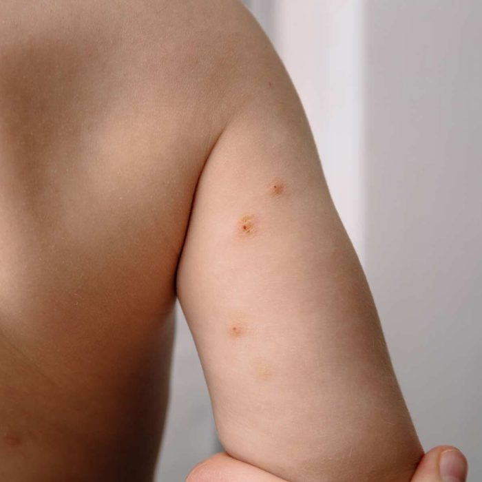 Molluscum-contagiosum Molluscum-contagiosum