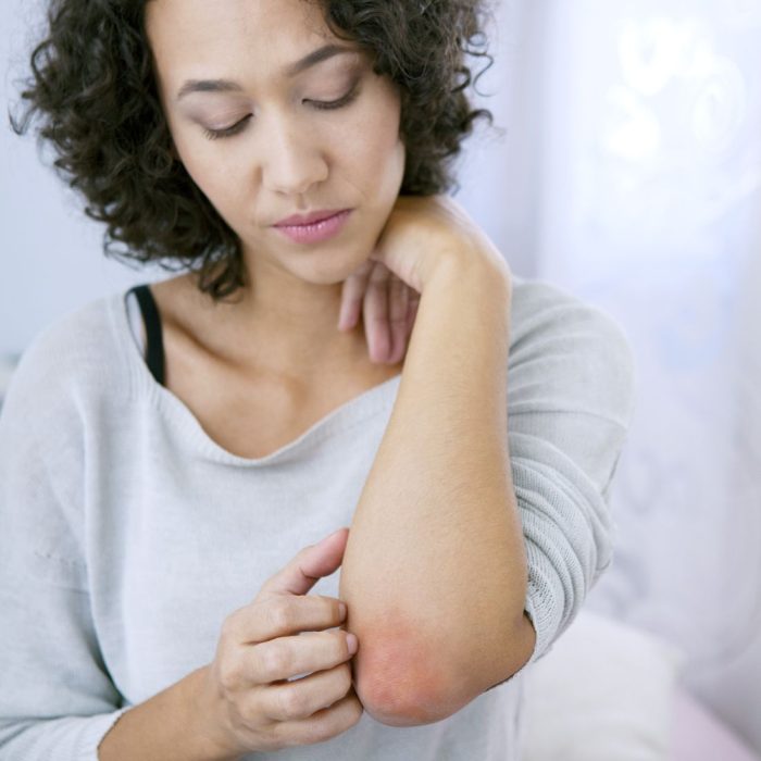 eczema – sfd eczema - sfd