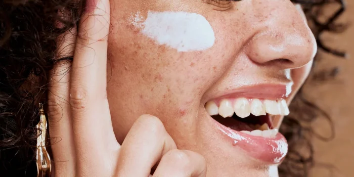 melasma - sfd