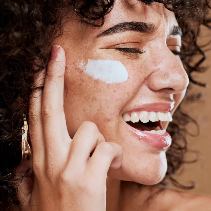 melasma - sfd