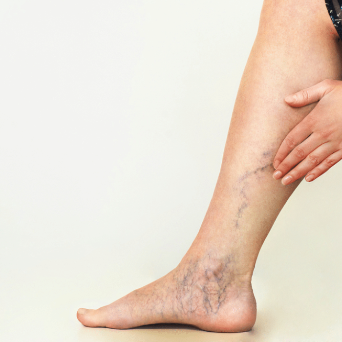 sclerotherapy